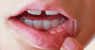 প্রায়ই মুখে ঘা হয়?